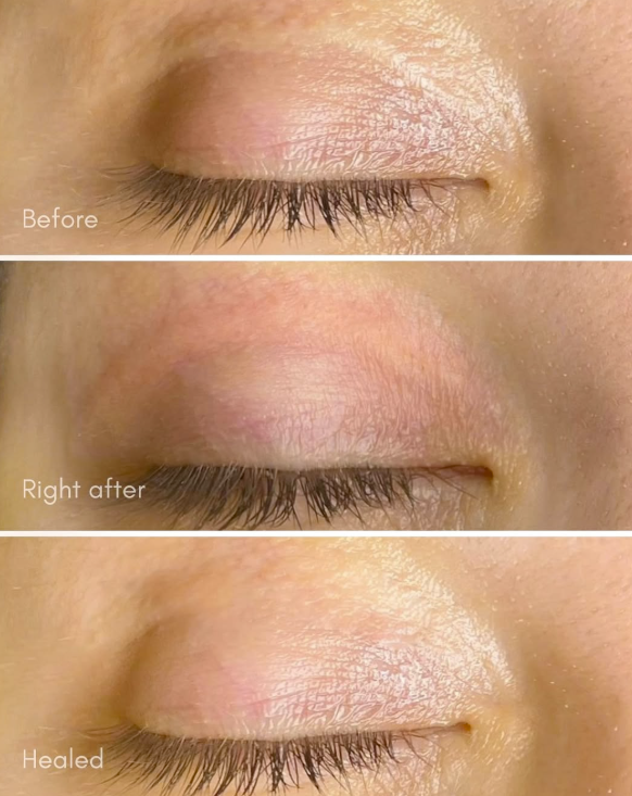 Eyelid scar revision shown before treatment, immediately after treatment, and healed