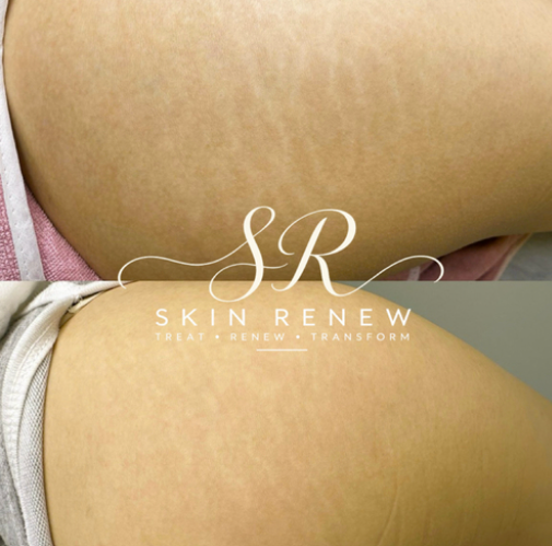 Inkless revision treatment shown before and after healing