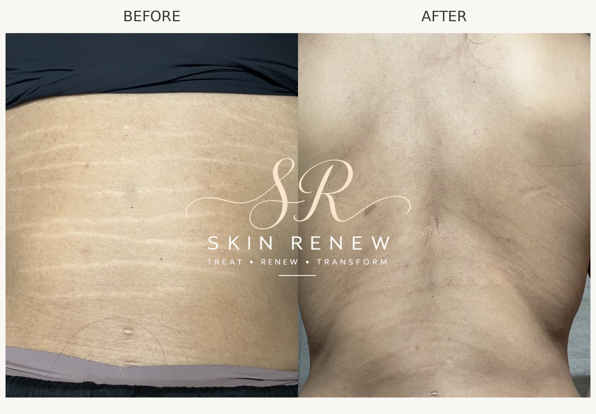 Inkless stretch mark revision results shown before and after treatment