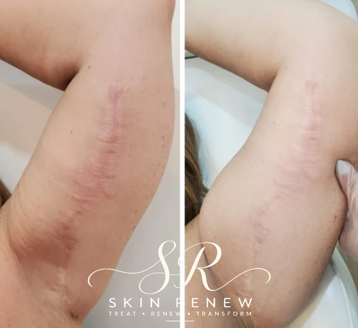 Scar camouflage results shown before and after treatment